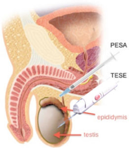 Extracción Espermática Testicular Mediante Biopsia 1
